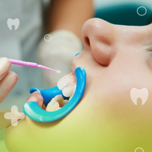 لمینت دندان چیست؛ مراحل و انواع لمینت دندان کدام است ؟